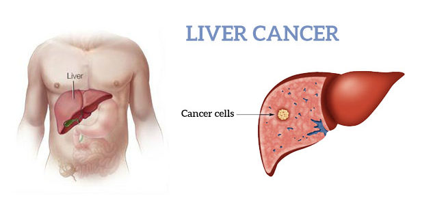 liver damage treatment in Delhi cusp surgeons 633x300 - Learn about the Symptoms of a Liver Cyst